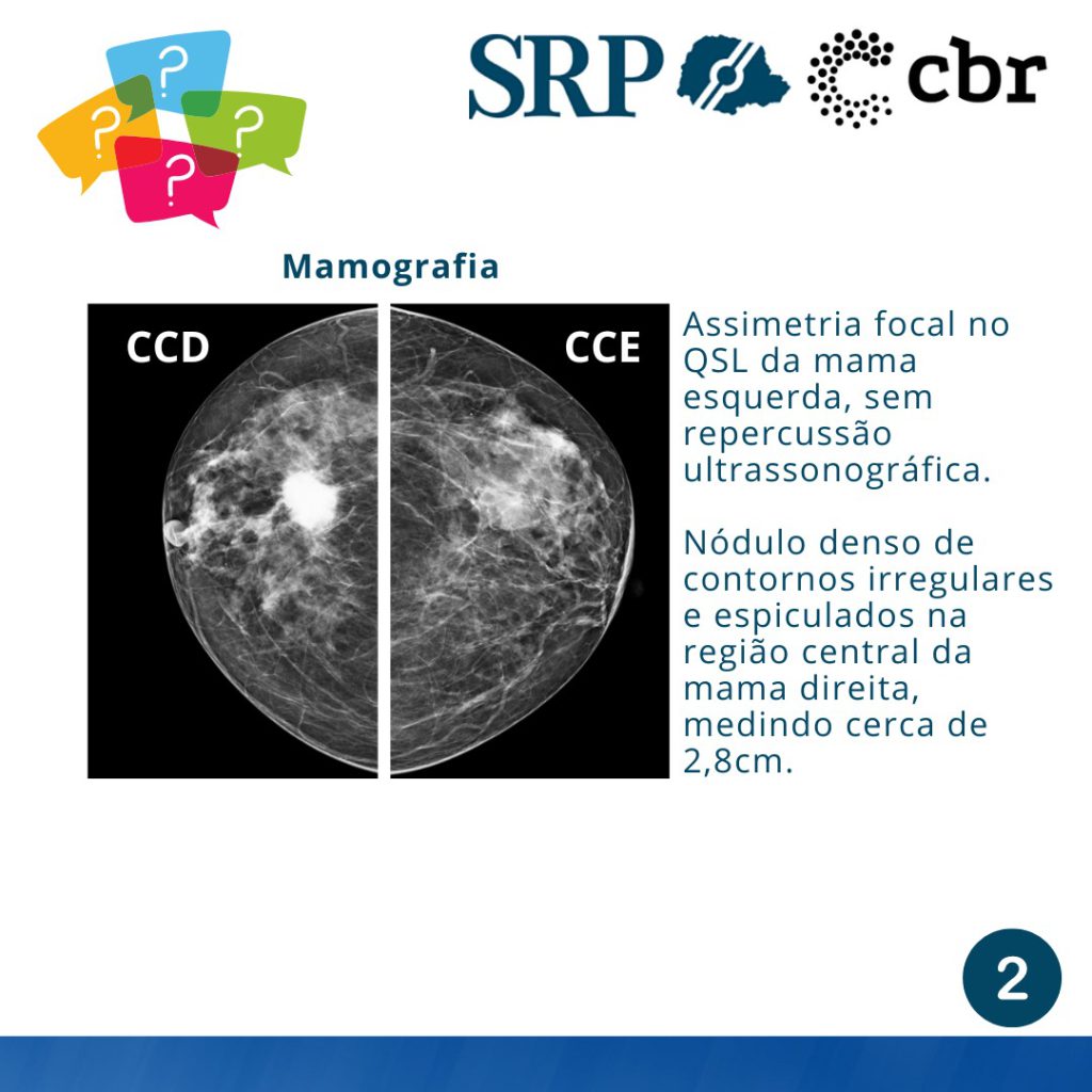 Caso do Dia Paciente com nódulo na axila direita Sociedade de Radiologia do Paraná